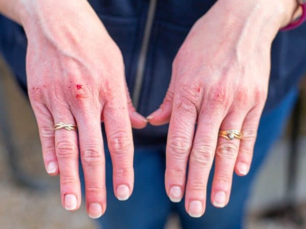 Signs and Symptoms of Methamphetamine Abuse